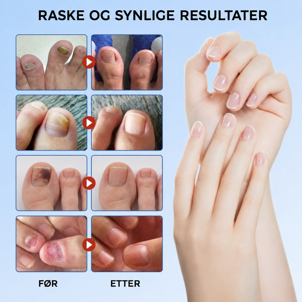FungalPatch – antibakterielle sopphemmende plaster og neglepleiesett