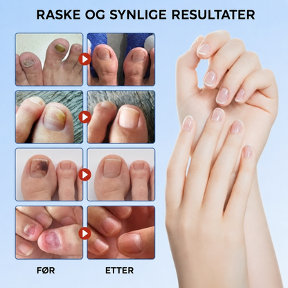 FungalPatch – antibakterielle sopphemmende plaster og neglepleiesett